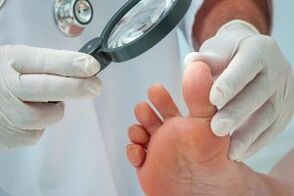 Plantar siğillerin tedavisi