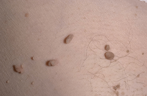 Papilloma