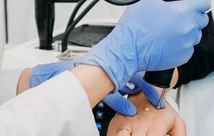 siğilleri ortadan kaldırmanın yolları