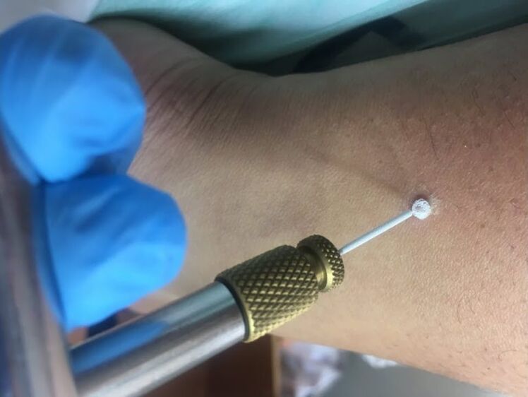 siğilleri ortadan kaldırmanın yolları