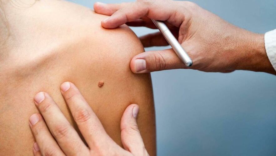Papillomalı bir hastayı inceleyen dermatolog