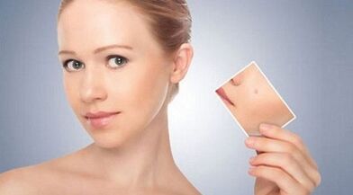 Siğiller ve papillomlar için etkili ilaçların gözden geçirilmesi