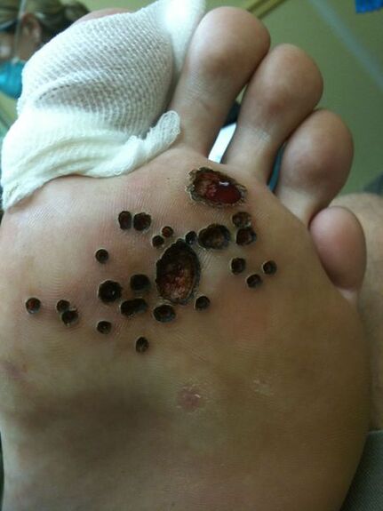 Bacakta siğillerin lazer çıkarılmasından sonra cilt