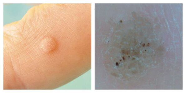 Sınav ve dermatoskopi sırasında sıradan siğil