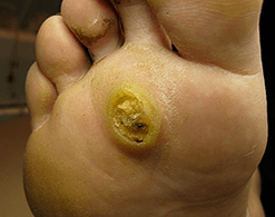 Subanary Papillomalar
